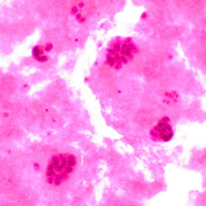 Mendeteksi Kanker Payudara Dengan Machine Learning